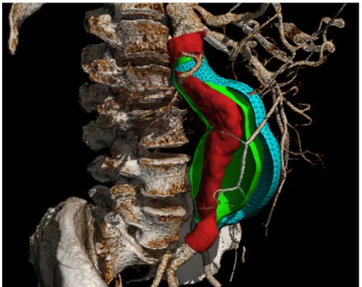 Figure 2.2: Three-dimensional mesh rendering of AAA at baseline and follow-up. 