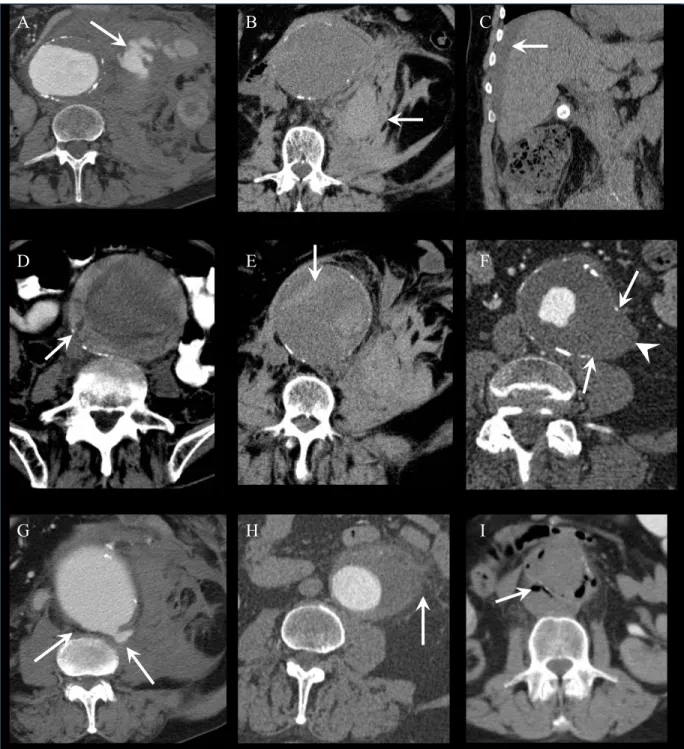 Figure 2.6: Signs of AAA rupture on CT in different patients.  