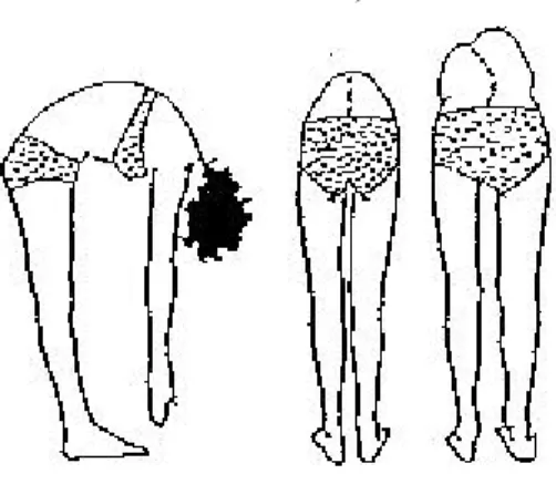 Figure 4 : Test d’Adam (flexion antérieure du tronc) 