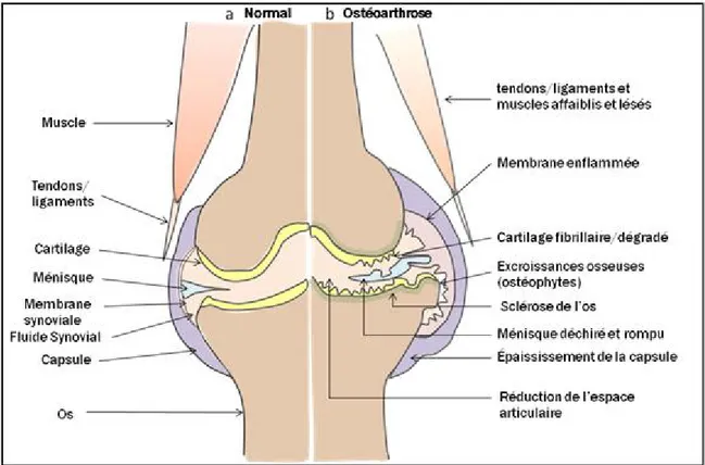 Figure 1 : Les structures articulaires affectées dans l’ostéoarthrose (OA). (a) articulation  normale