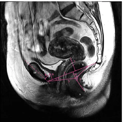 Figure  8.  Méthode  de  mesure  des  paramètres  morphologiques  des  muscles  du  plancher pelvien et de support des organes pelviens dans le plan sagittal