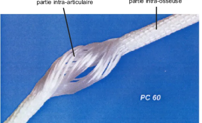 Figure 06: Portion intra-articulaire   et intra-osseuse du LARS 