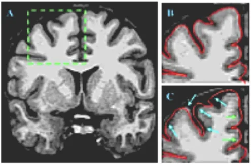 FIG.  1.16    Démonstration  qualitative  du  déplacement  des  frontières  des  tissus  cérébraux dûe à la non linéarité des gradients