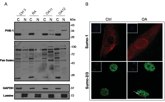 Figure 5 : Les protéines SUMOs s’accumulent aussi dans le noyau des  chondrocytes articulaires des patients OA par rapport aux sujets sains