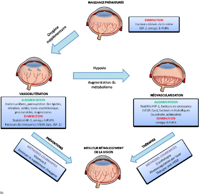 Figure 3. La rétinopathie du prématuré.  Les prématurés naissent avec une microvasculature qui n’est pas  encore complètement développée