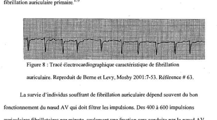Figure 8 : Tracé électrocardiographique caractéristique de fibrillation  auriculaire. Reproduit de Berne et Levy, Mosby 2001:7-53