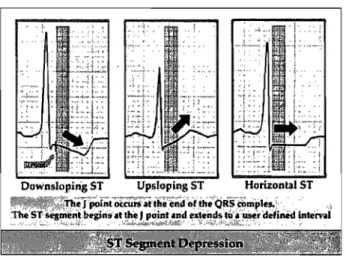 Figure  4 : Les anomalies du segment ST  à  l'ECG sont souvent des indices d'ischémie myocardique 