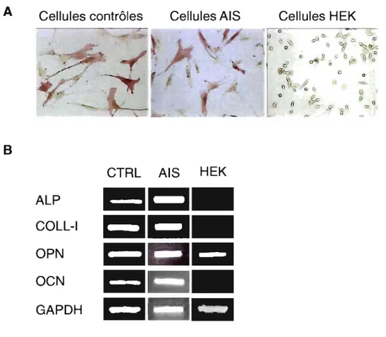 Figure  3:  Expression  de  différents  marqueurs  ostéoblastiques  dans  les  cellules  dérivées  de  patients  scoliotiques  et  de  cel1ules  humaines  embryionnaire  de  rein  (lignées HEK)
