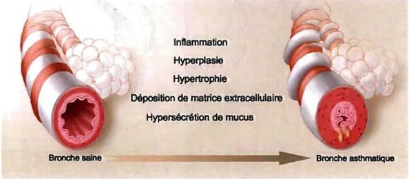 Figure  1.2.  Résumé des différentes causes potentielles menant au remodelage des voies  respiratoires présent dans la physiopathologie de  l'asthme