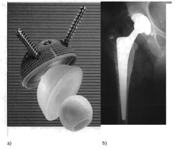 Figure  1 :  prothèse  totale  de  hanche  conventionnelle:  a)  cupule  acétabulaire  non  cimentée  (avec  vis),  pièce  de  polyéthylène  et  tête  de  28mm  de  diamètre  b)  radiographie post opératoire démontrant l'installation d'une PTH c) tige fémo