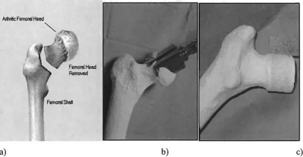 Figure 2  :  préparation  du  fémur  pour recevoir  une a)  PTH  (résection  de  la tête  et  du  col  fémoral)  et  b)  et  c)  un  resurfaçage  (fonnation  d'un  cylindre  osseux  avec  résection de la partie sphérique de la tête fémorale seulement)