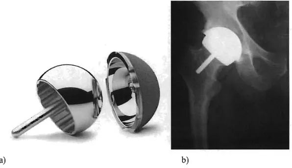 Figure  3 :  a)  composante  fémorale  de  resurfaçage  et  sa  composante  acétabulaire  correspondante  et  b)  radiographie  post  opératoire  d'un  resurfaçage  total  de  la  hanche