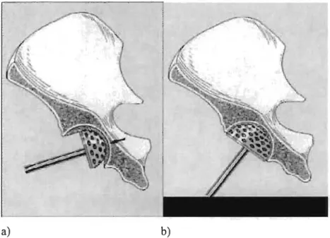Figure  4:  technique  de  préparation  classique  de  la  cavité  acétabulaire  avec  a)  approfondissement  du  fraisage  jusqu'au  fond  de  la  cavité  et  b)  utilisation  de  fraises  de  diamètre plus grand pour obtenir un saignement adéquat de l'os
