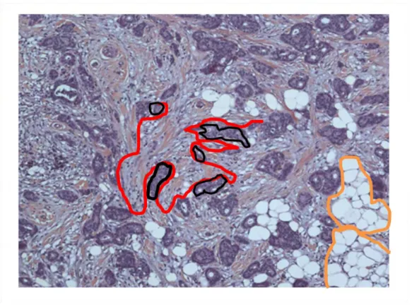 Figure 6 : Photographie, d'une préparation microscopique, d'un adénocarcinome  canalaire  invasif  du  sein  :  Hémalun  éosine  (HE)  grossissement  X100