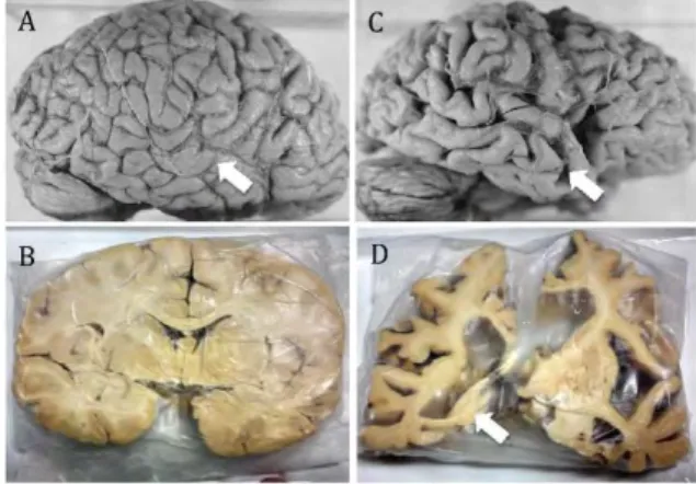 Figure I.A-2: Neuroanatomical comparison of normal brain (A, B) and AD brain (C, D). Prominent  atrophy in C compared with A (arrows)