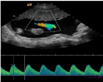 Figure 1.11: Duplex Doppler US image showing both B-mode image and the doppler image [ Kouamé 2015 ].