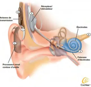 Figure 1-1 L’implant cochléaire. 