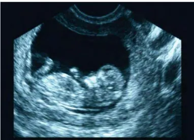 Figure 1.1 – Exemple d’image ultrasonore utilis´ ee pour le suivi du fœtus chez la femme enceinte [ Szabo , 2004 ].