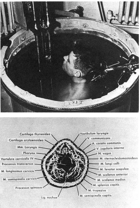 Figure 1.5 – Premi` ere installation ultrasonore pour l’annotation de la nuque r´ ealis´ ee par Douglass Howry en 1954 [ Szabo , 2004 ].