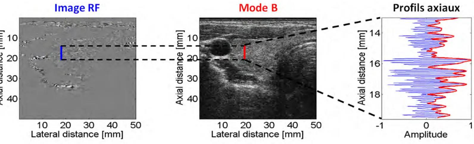 Figure 1.20 – Correspondance entre mode RF et mode B pour une image de thyro¨ıde [ Basarab ,