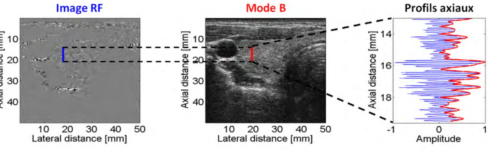 Figure 1.20 – Correspondance entre mode RF et mode B pour une image de thyro¨ıde [ Basarab ,