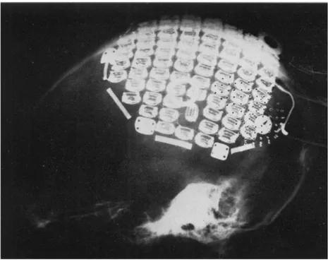 Figure  29:  Radiographie  d'une  matrice  d'électrodes  posée  sur  l'hémisphère  droit  du  cerveau  d'un  patient  atteint d'un glaucome aux deux yeux (Brindley and Lewin, 1968) 
