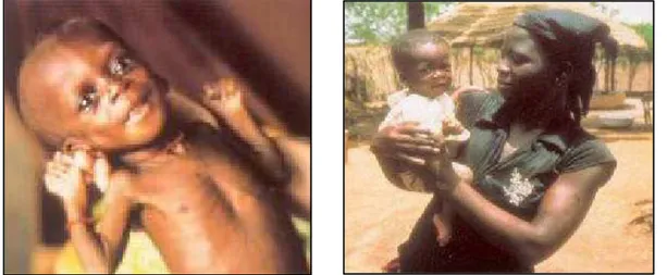Figure 2.8 : Photo d'un enfant dénutri ayant été traité avec 10 g/j de spiruline au Togo [73]