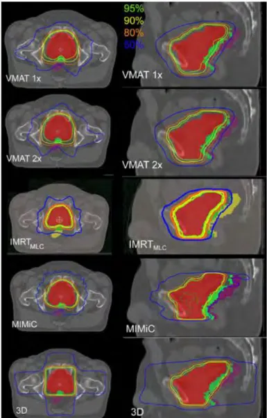 FIG. 1.8- Distributions de dose dans les plans axial et sagittal pour différentes  modalités de traitement
