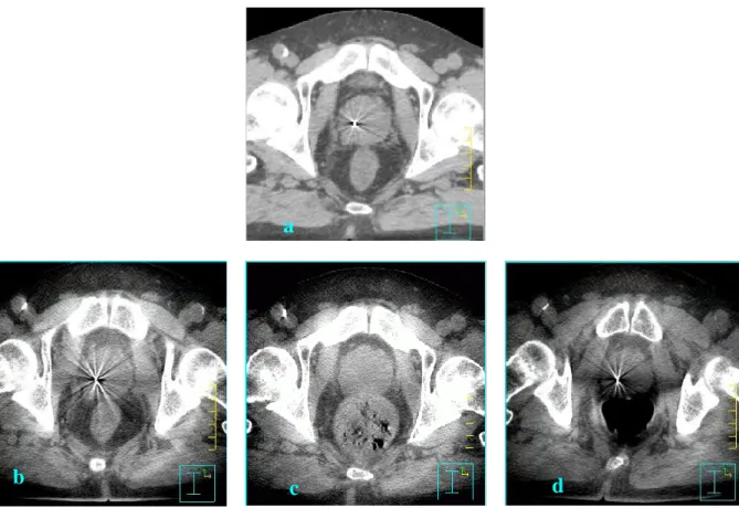 FIG. 2.2- Coupes transverses passant par la prostate et fusionnées avec le CT de  planification montrant la mobilité prostatique en fonction de la réplétion rectale, 
