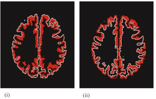 Figure 7.b: Dilatation de la substance blanche et du LCS et détermination des surfaces interne et  externe du manteau cortical