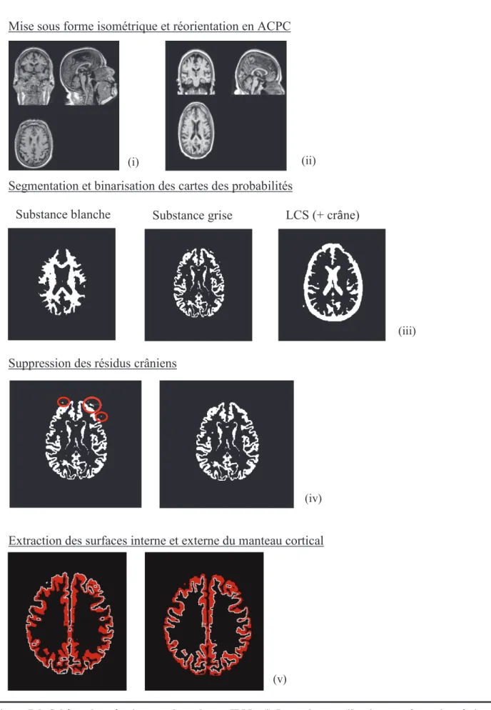 Figure  7.d:  Schéma  de  prétraitement  des  volumes  IRM ;  (i)  Image  brute ;  (ii)  mise  sous  forme  isométrique  et  réorientation  en  ACPC;  (iii)  Segmentation et  binarisation  des  cartes  des  probabilités ;  (iv)  Détection  et  suppression 