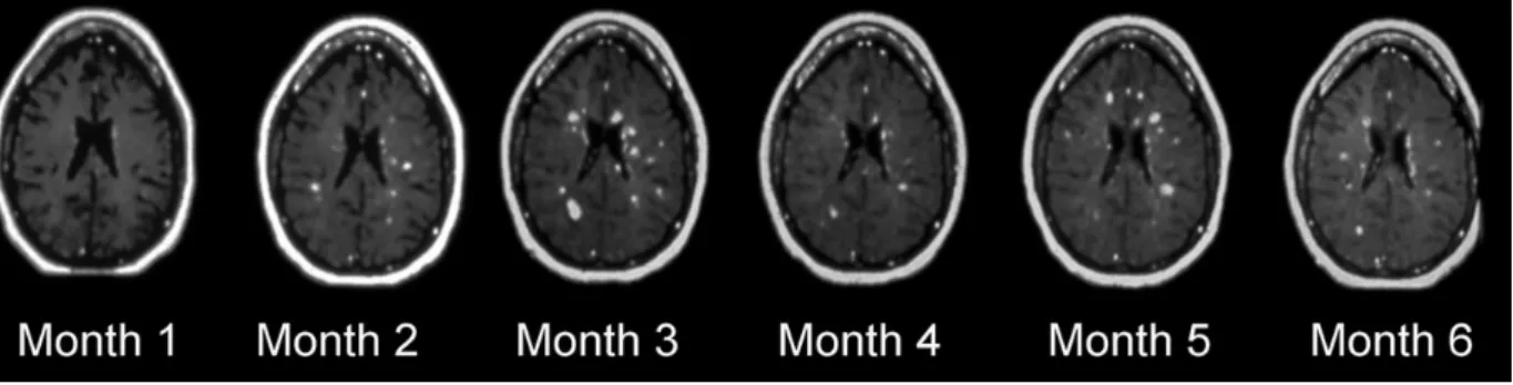 Figure II-5 : Rehaussement par le Gadolinium des lésions de sclérose en plaques durant 6 mois chez une 