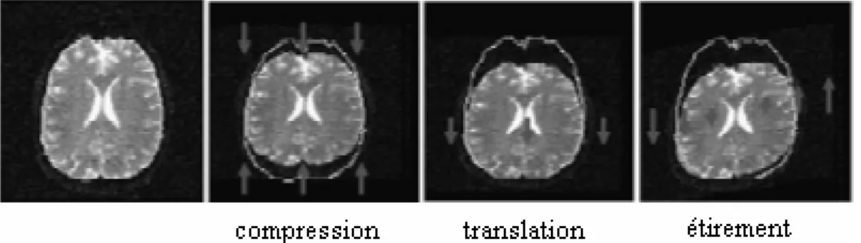 Figure IV-3 : Effets des courants de Foucault sur une image pondérée en diffusion 