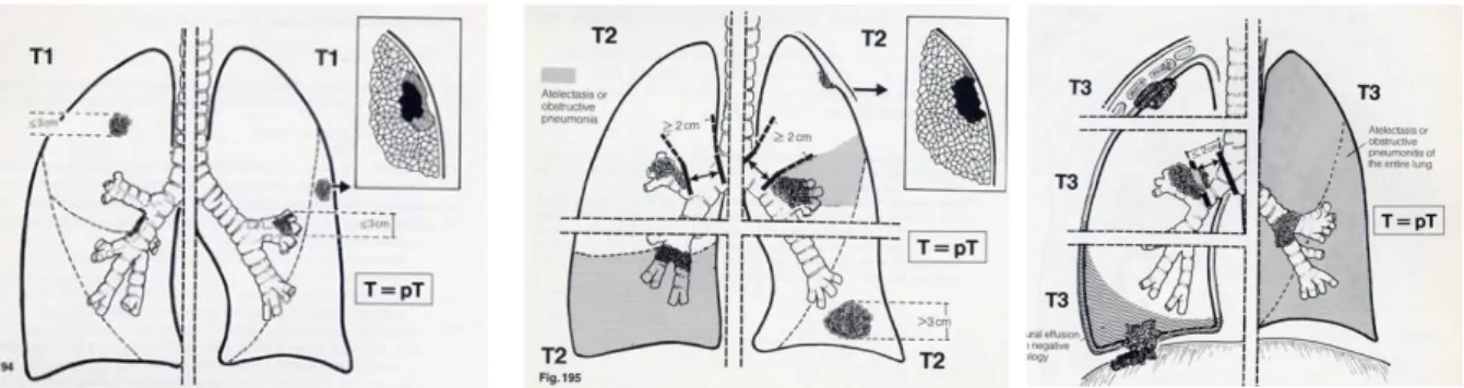Figure 29: Valeur de T selon la localisation et la taille des tumeurs pulmonaires. 