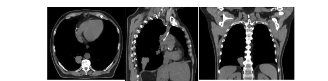 Figure I-3 : Images de scanner thoracique, coupe axiale, sagittale et coronale. 