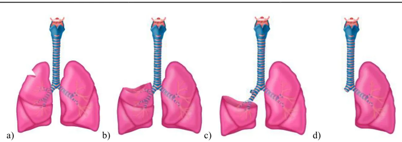 Figure I-4 : Procédures de résections pulmonaire ; a) résection en coin ; b) segmentectomie ; c) lobectomie ; d)  pneumonectomie