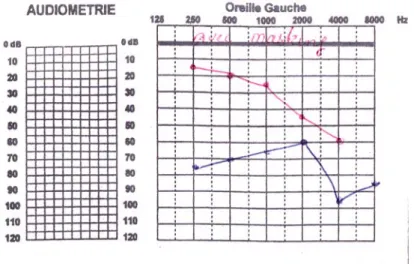 Figure 1 : Audiogramme avec perte de transmission.