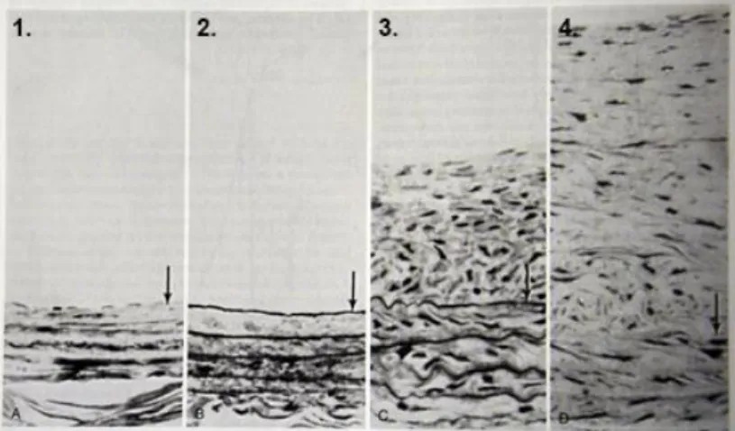 Figure 1 - 5. Artère de rat après blessure [9] 1. Vaisseau normal.   2. Vaisseau dénudé d’endothélium à 2 jours