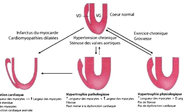 Figure  1.  Les divers types d'hypertrophie cardiaque 