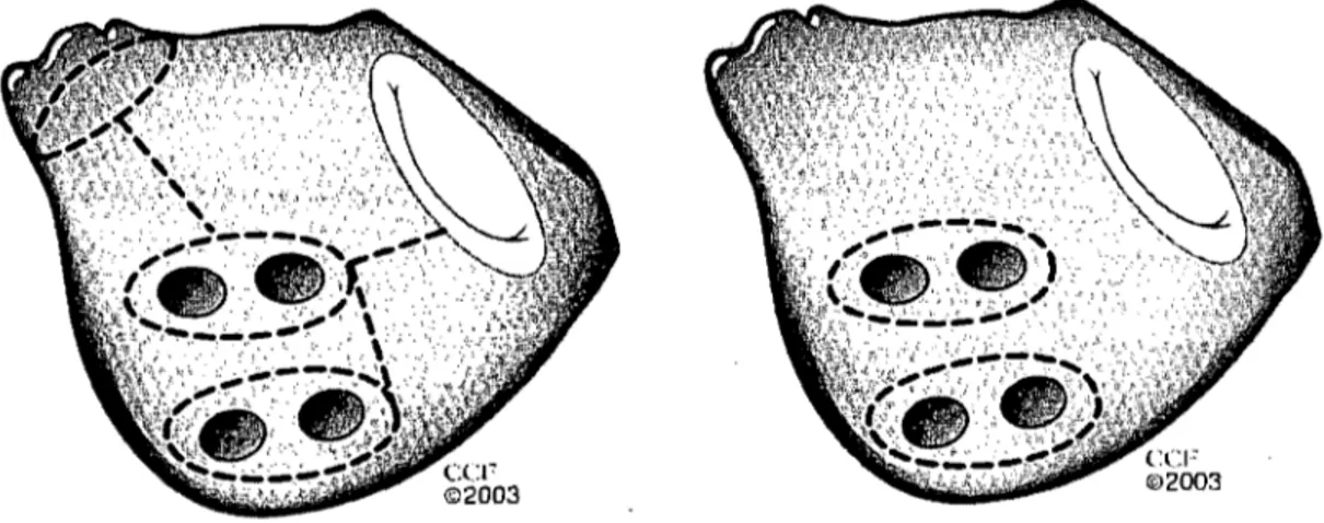 Figure  1.  Les  lignes  d'ablation  utilisée  dans  le  traitement  invasif de  la  fibrillation  auriculaire