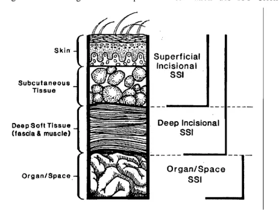 Figure  4.  Vue  sagittale  de  la  plaie:  Classification  des  ISO  selon  la  profondeur