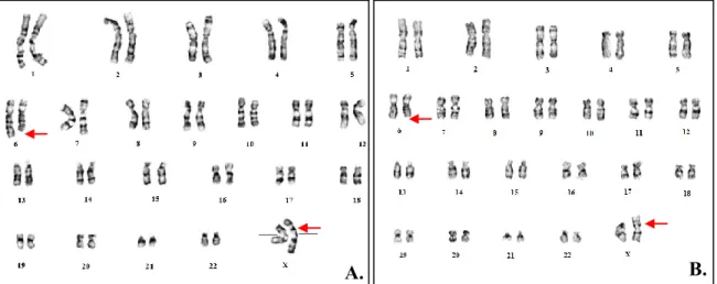Figure 11: Caryotypes des patients 1 et 2 présentant la formule chromosomique  46,XX,ins(X;6)(p11.2;q21q23)