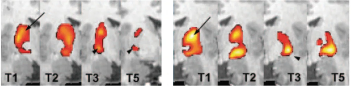 Figure  3.  Transfère  du  substrat  neuronal  soutenant  l’exécution  d’une  séquence  de 