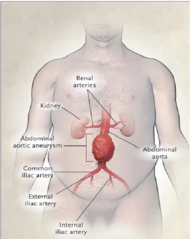 Figure 1: Anévrysme de l’aorte infrarénal 