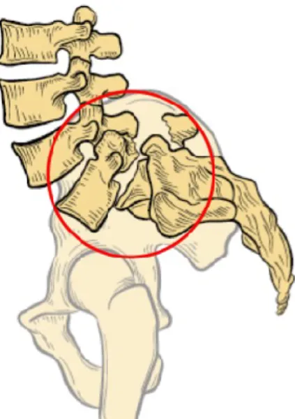 Figure 1 – Spondylolyse et Spondylolisthésis. 