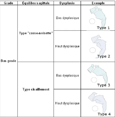 Tableau  III  –  Classification  du  spondylolisthésis  développemental  de  bas  grade  selon Mac-Thiong et Labelle 52 
