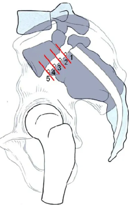 Figure 4 – Classification de Meyerding.  Grade I est 0-25% de glissement, Grade II est  de 26-50% de glissement, Grade III est de 51-75%, Grade IV est de 76-100% et le Grade 