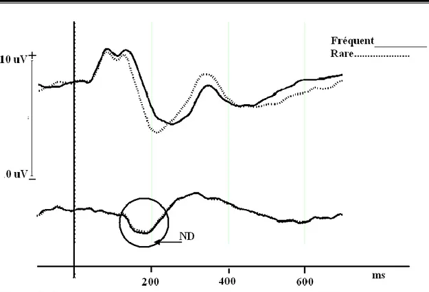 Figure  2.  Exemple  d’une  onde  de  négativité  de  discordance  (ND)  obtenue  chez  un  enfant de dix ans en soustrayant le tracé fréquent (syllabe /ba/) du tracé rare (syllabe  /da/)