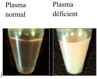 Figure 4 : Plasma d’un patient sans déficience en LPL et d’un patient atteint d’une  hyperchylomicronémie familiale 