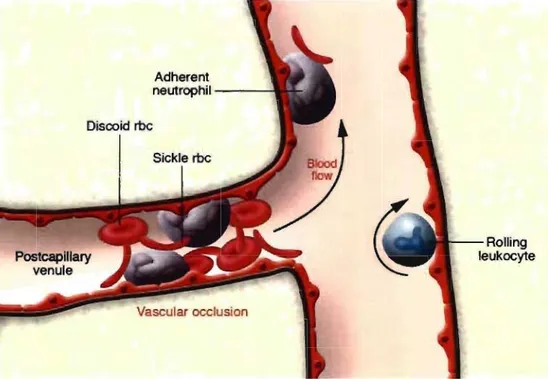 Figure  Il.  Simplified  view  of  a  vaso-occlusive  process  in  sickle  cell  disease